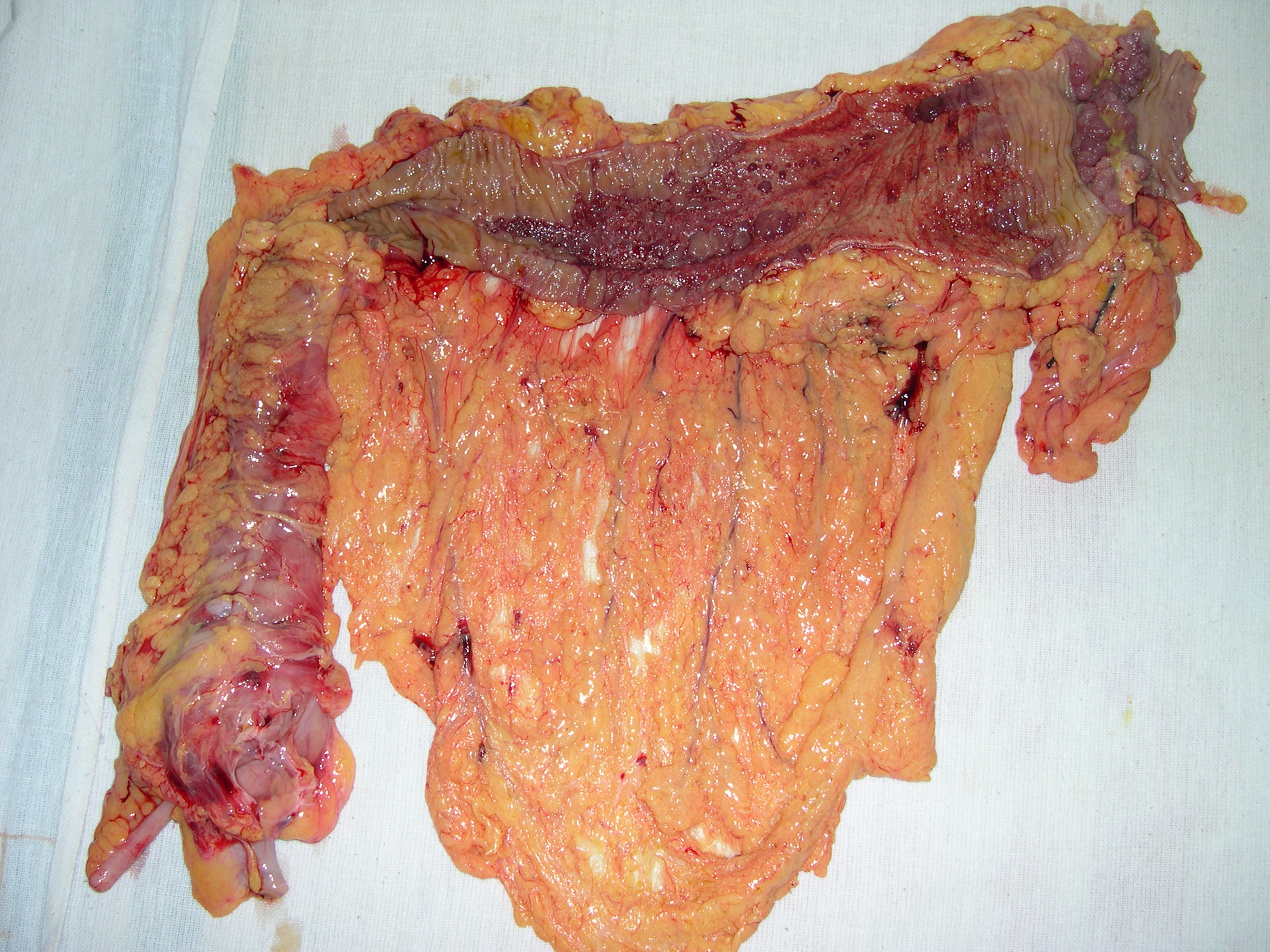 colon cancer splenic flexure 2.9.25a