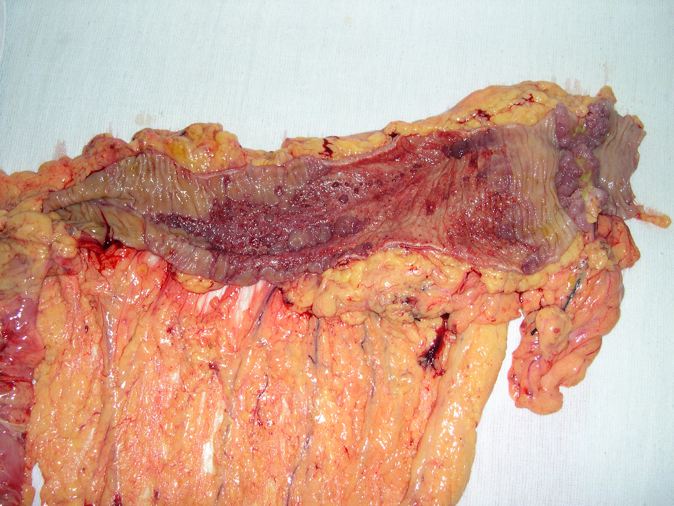 colon cancer splenic flexure 2.9.25b
