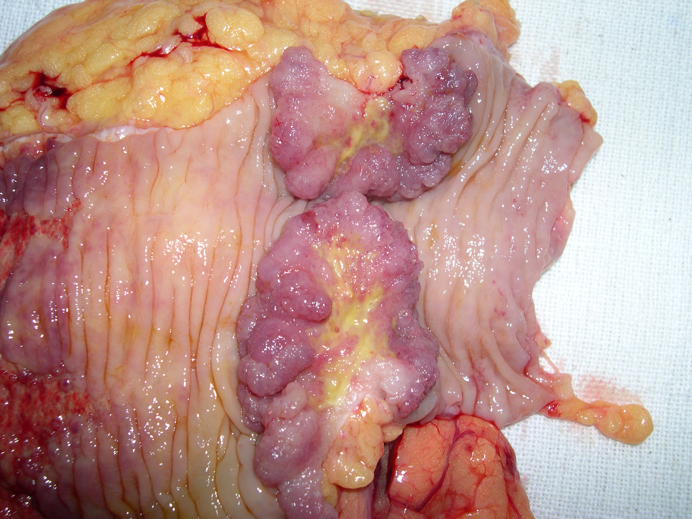colon cancer splenic flexure 2.9.25d