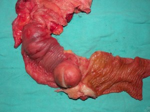 intussusception, ileocolic 15.12.11 fibrolipoma 3 cm,a