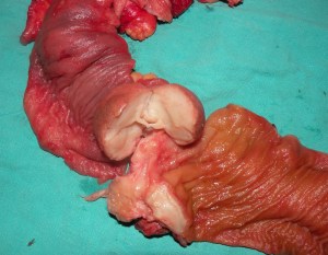 intussusception, ileocolic 15.12.11 fibrolipoma 3 cm,c