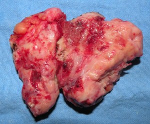 breast abscess chronic 19.7.12.2