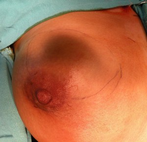 breast abscess chronic 19.7.12