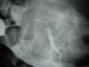 parotid sialography stone duct