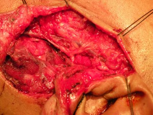 parotidectomy 23.10.12