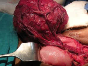 mesenteric fibromatosis