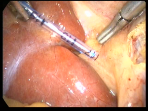 Rouviere's sulcus