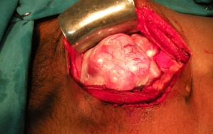 tumor of UDT