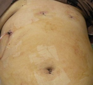 heterotaxoa3, truncated pancreas