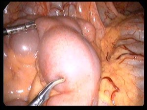 small bowel stricture bhukki 24,10, 14a