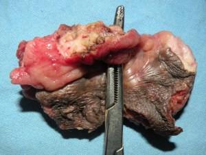 cancer anus