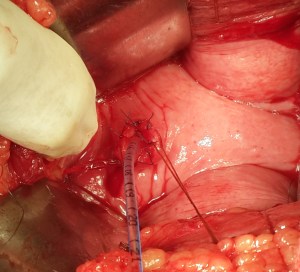 ureterocele repair 28.11.13