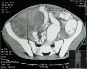 mesenteric fibromatosis9