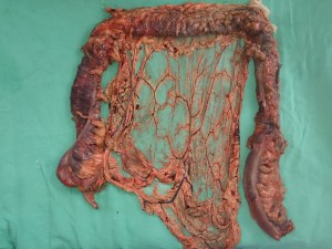 colectomy subtotal 11.8.14