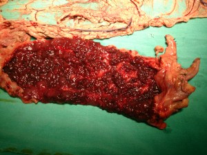 colectomy subtotal 11.8.14a