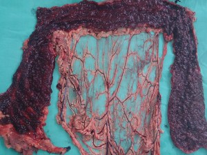 colectomy subtotal 11.8.14e