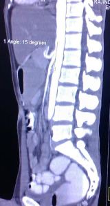 SMA syndrome 14.8.14c