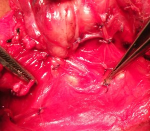 PTC total thyroidectomy 7.2.15c