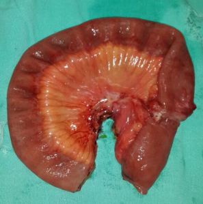 adhesions and stricture post CS 14.2.15b