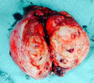testicular tumor 4.4.15a