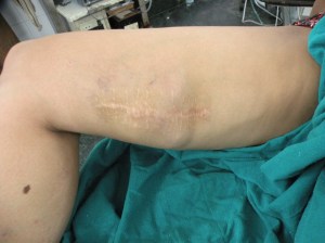 neurilmmoma thigh 10.6.15a