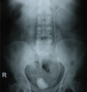 stone on stent 12.9.15a