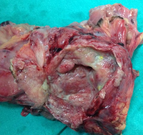 abscess cavity 1