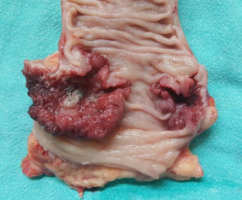 rectosigmoid cancer 18.6.16b