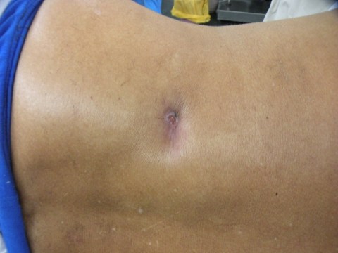 XPN with renocutaneous fistula 22.3.17a