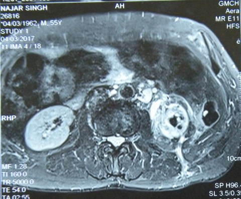 XPN with renocutaneous fistula 22.3.17a2