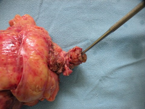 XPN with renocutaneous fistula 22.3.17g