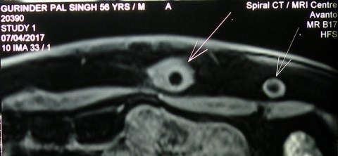 disulfiram implants 8.4.17a