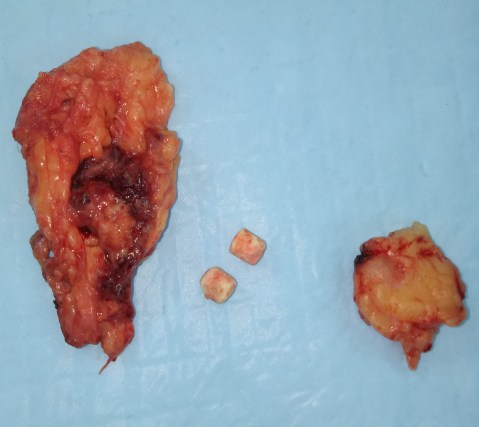 disulfiram implants 8.4.17f