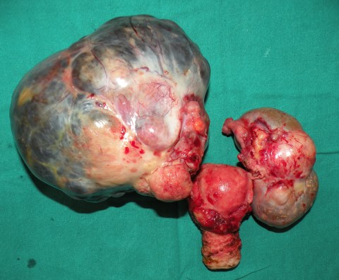 ovarian cancer 10.8.17c