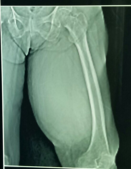 STS masquerading as abscess2