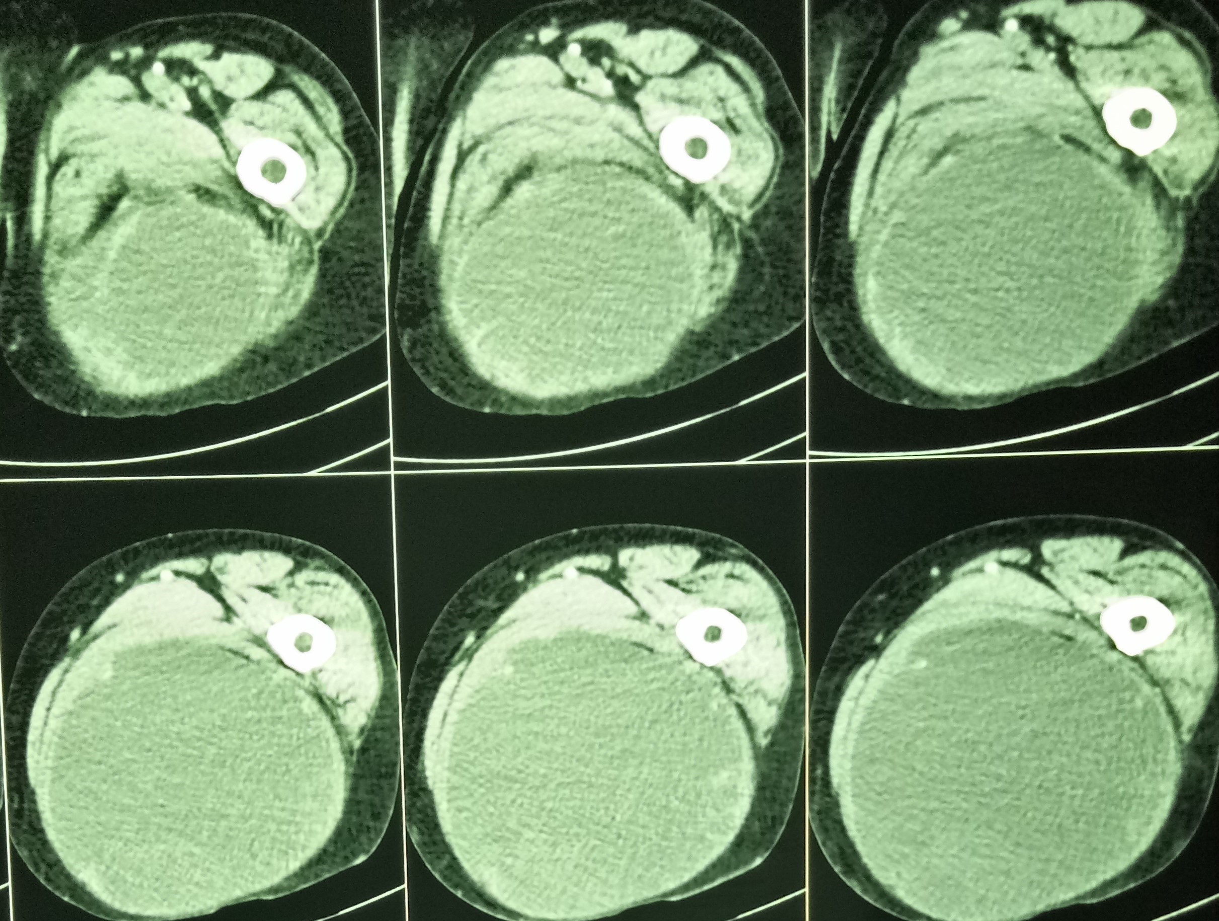 STS masquerading as abscess3