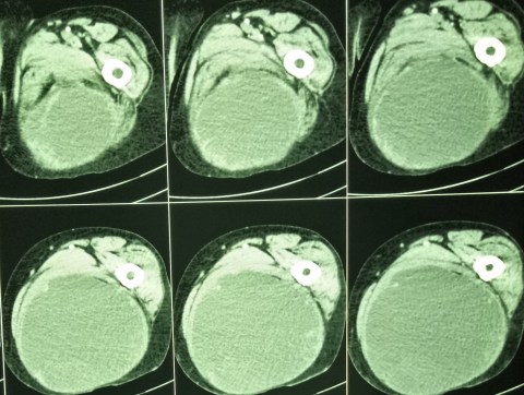 STS masquerading as abscess3