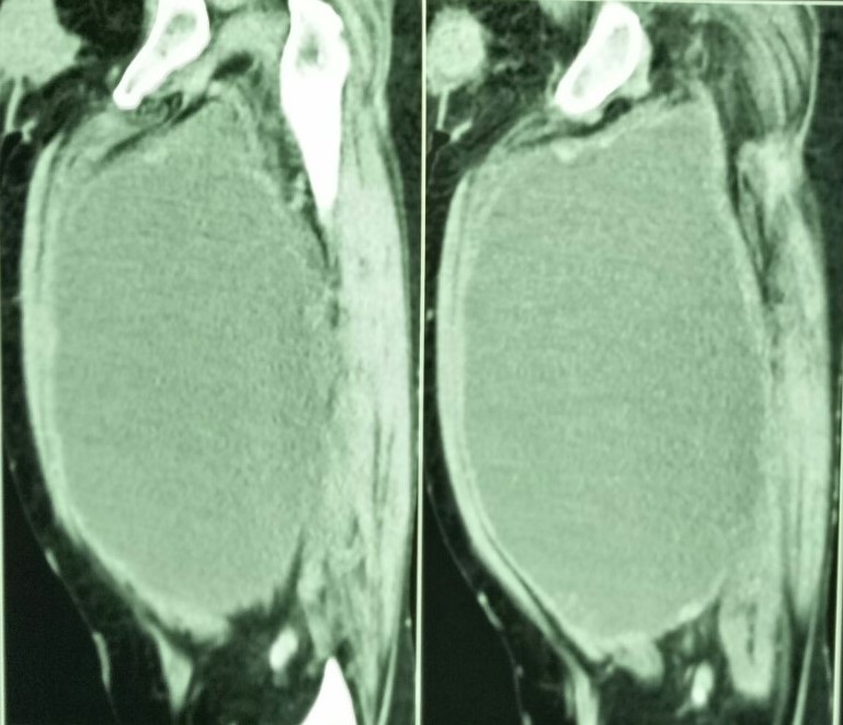 STS masquerading as abscess4