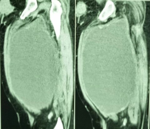 STS masquerading as abscess4