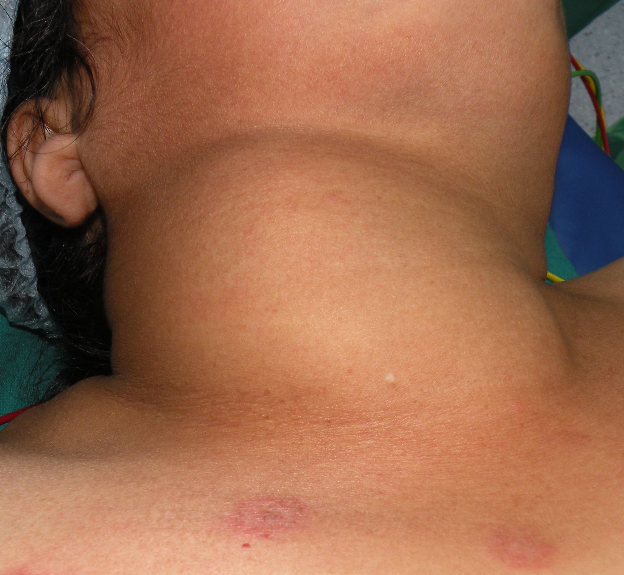 thyroidectomy january25, 2018b