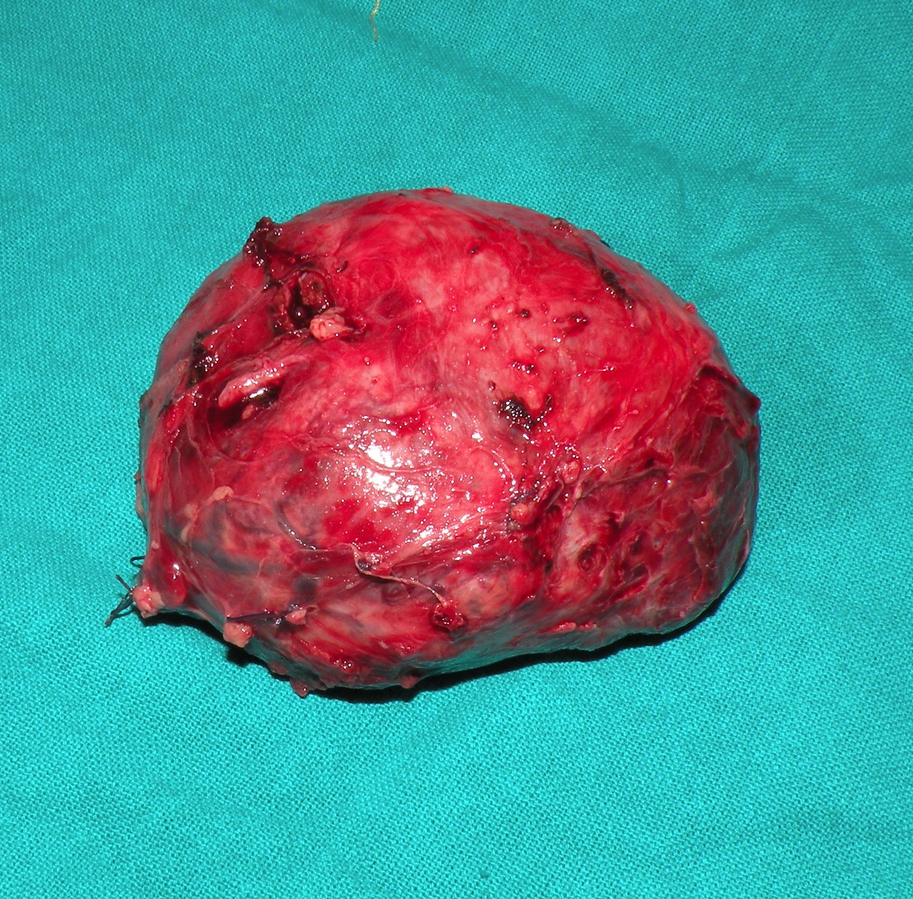 thyroidectomy january25, 2018c