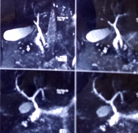 20.10.18 no cbd stones1