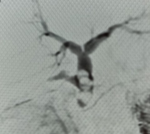 21.8.18b. cbd stones