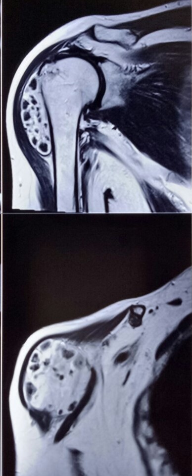hamartoma 1.4.19a (2)